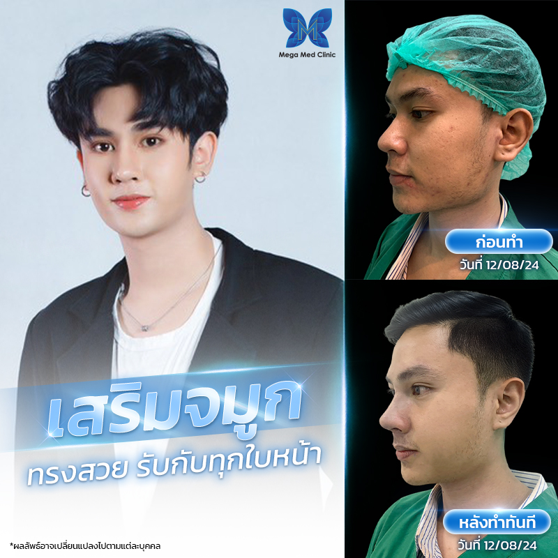 รีวิวจมูก 1