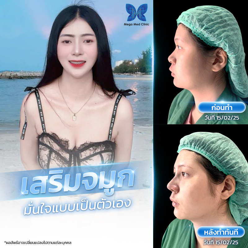 รีวิวจมูก 2