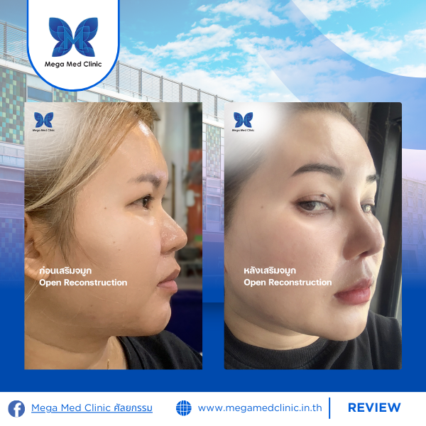 รีวิวเสริมจมูก Mega Med Clinic