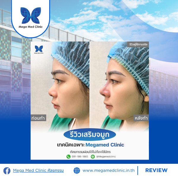 รีวิวเสริมจมูก Mega Med Clinic