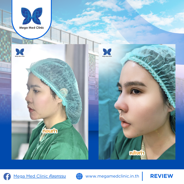 รีวิวเสริมจมูก Mega Med Clinic